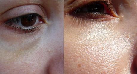 Cómo quitarse un quiste de la cara y ahorrarse 100 euros (o más)