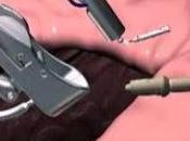 Método Apollo- Reducción Estómago cirugía