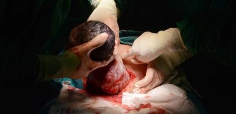 MI SEGUNDA CESÁREA MI SEGUNDA CESÁREA