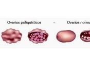 Síndrome Ovarios Poliquísticos. ahora qué?