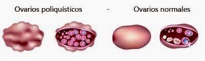 Síndrome de Ovarios Poliquísticos. ¿Y ahora qué?