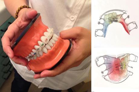 ortodoncia infantil 4