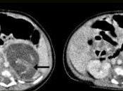 Nace Hong Kong bebé "embarazado" gemelos
