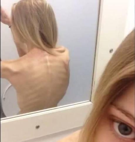 «La anorexia no se detendrá hasta que mueras»