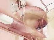 Llega prótesis pene