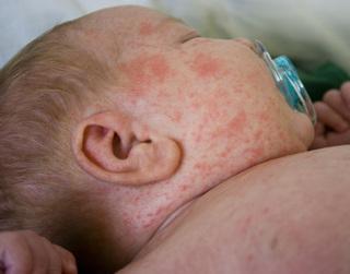 Sudamina: una erupción en la piel de tu bebé