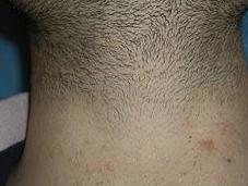 Crece número hombres depilan barba cuello zona genital