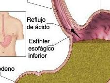 Tratamiento natural reflujo gastroesofágico