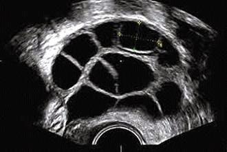 Baja Reserva Ovárica