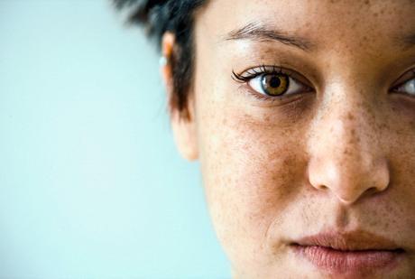 Porque se Forman Manchas en la Piel por el Sol y como evitarlas.