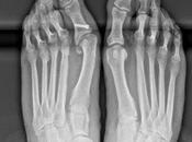 Reintervención caso cirugía fallida hallux valgus