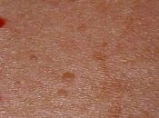 Lunares rojos piel como puedo prevenirlos
