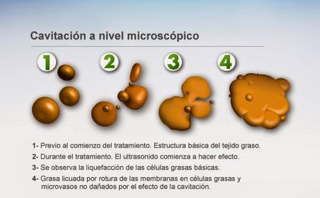 LA CAVITACIÓN ULTRASÓNICA