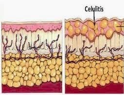 LA CELULITIS