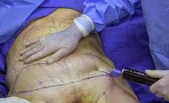 LA CELULITIS LA CELULITIS