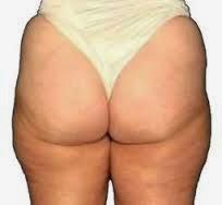 LA CELULITIS LA CELULITIS