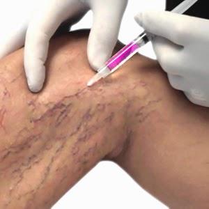 LAS VARICES LAS VARICES