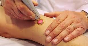 LAS VARICES LAS VARICES