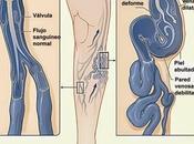 varices