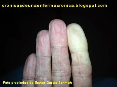 De cómo un dedo blanco trajo consigo dos nuevos diagnósticos