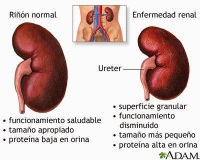 Patología Renal asociada a la Práctica Deportiva