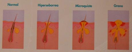 “Cleanance” de AVÈNE – la línea de cuidados para pieles grasas y con tendencia acnéica