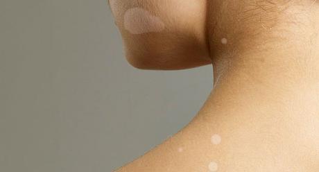 Remedios caseros para eliminar manchas blancas en la piel (hongos) -  Paperblog