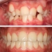 Gingivitis: remedios caseros para su tratamiento