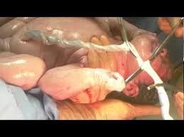 Pinzar el Cordón Umbilical a los dos minutos es lo mejor