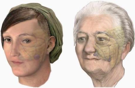 CONFERENCIA EN LA ACADEMIA AMERICANA (3): AVANCES EN LA INYECCIÓN DE RELLENOS