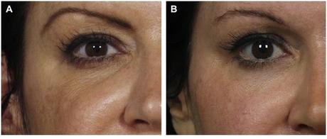 CONFERENCIA EN LA ACADEMIA AMERICANA (3): AVANCES EN LA INYECCIÓN DE RELLENOS