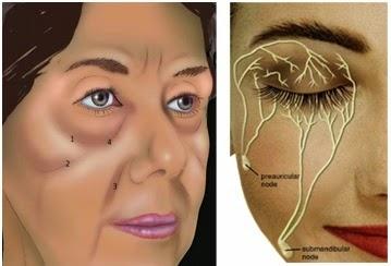 CONFERENCIA EN LA ACADEMIA AMERICANA (3): AVANCES EN LA INYECCIÓN DE RELLENOS