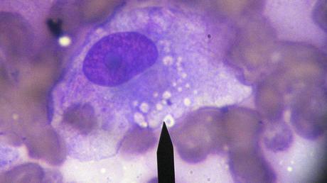 Mutaciones de tumores: la posible clave para la vacuna contra el cáncer