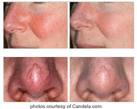 Qué es la cuperosis y cómo eliminarla vbeam-results-cuperosis