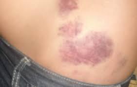 sueño con moratón o un hematoma