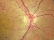 Aprueban Aflibercept Retinopatia Diabetica