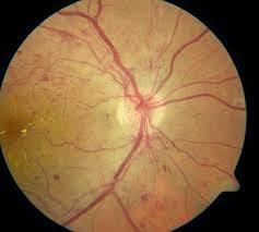 Aprueban el uso del Aflibercept en la Retinopatia Diabetica
