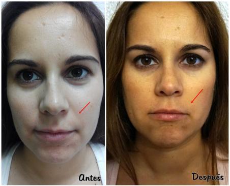 Iodase. Antes y Después