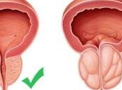 Conoce principales síntomas próstata inflamada