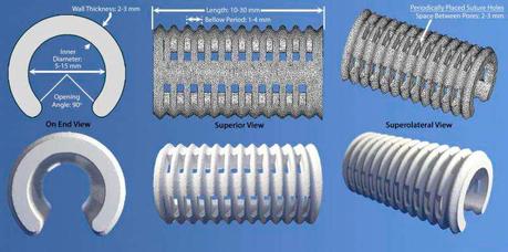 Impresión 3D para implantes en niños con malformación de traquea