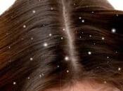 Efectivos Tratamientos Naturales para Caspa