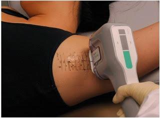 MIRADRAY: UNA SOLUCIÓN DEFINITIVA CONTRA LA HIPERHIDROSIS O SUDORACIÓN EXCESIVA