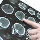 Hallan posible tratamiento para un tumor cerebral letal en niños - RPP Noticias