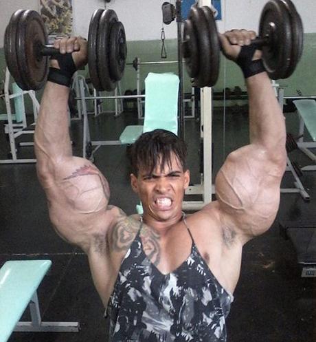 El “Hulk” humano casi pierde los brazos por inyectarse aceite (Fotos)