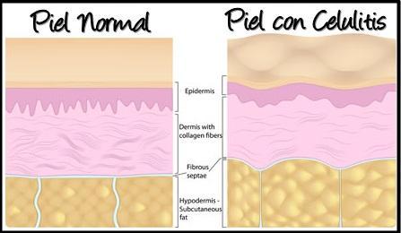 desarrollo-celulitis-