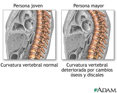 ¿Por qué nos encogemos al envejecer?