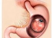 Tratamientos para obesidad sobrepeso