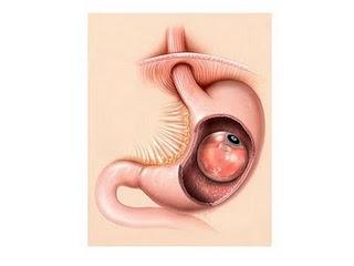 Tratamientos para la obesidad y el sobrepeso