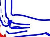 Bursitis Pilates