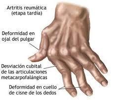 La Artritis